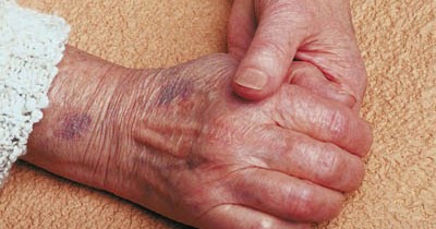 causas de hematomas en la piel en los ancianos